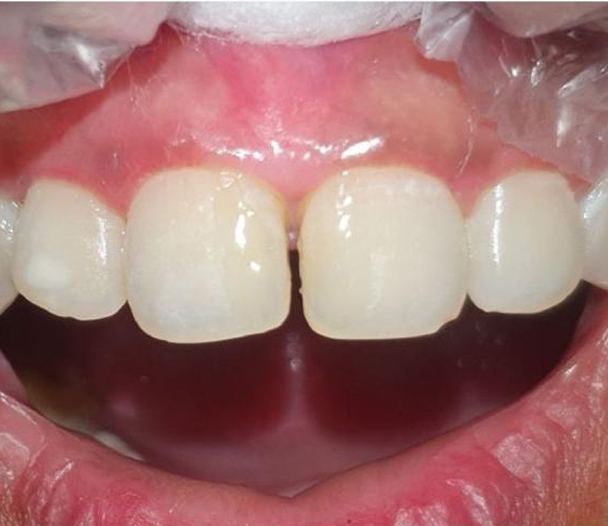 Dental Implants Kolkata