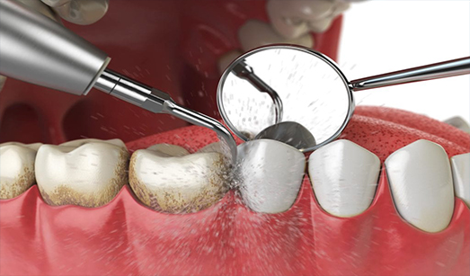 Dental Implants Kolkata