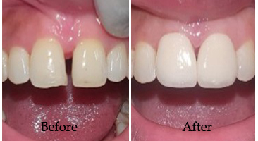 Teeth Braces Treatment Kolkata 