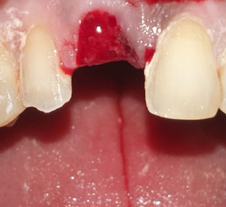 Dental Implants Kolkata