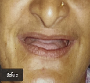 Dental Implants Kolkata