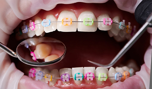 Teeth Braces Treatment Kolkata