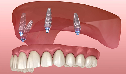 Teeth Braces Treatment Kolkata