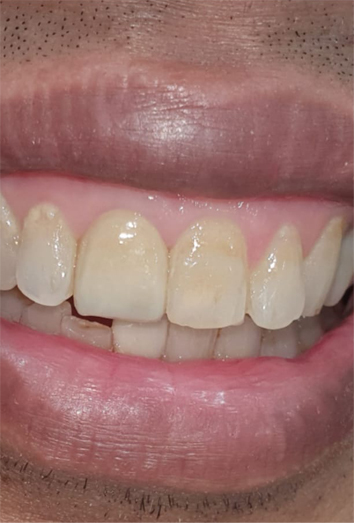 Teeth Braces Treatment Kolkata