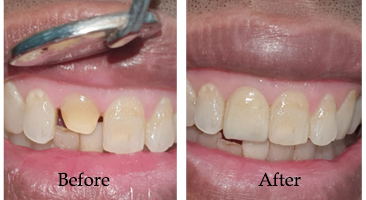 Dental Implants Kolkata 