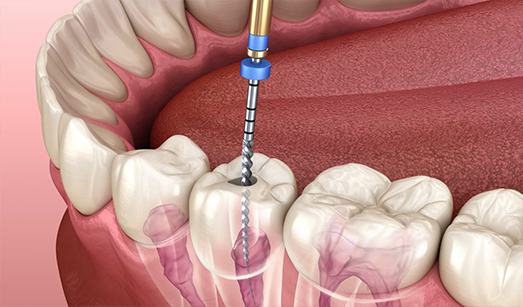 Dental Implants Kolkata