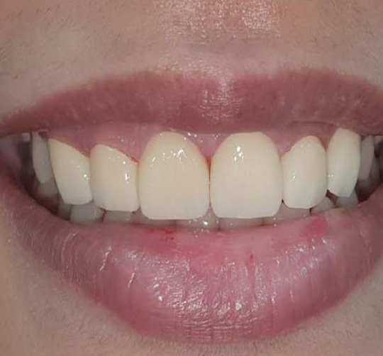 Teeth Braces Treatment Kolkata